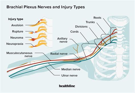 Brachial plexus injury .